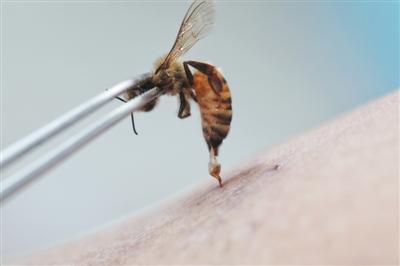9月28日,医生毕兆春正在对患者实施蜂疗,蜂针刺入皮肤.